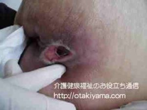 仙骨にできた褥瘡(じょくそう、床ずれ)の写真