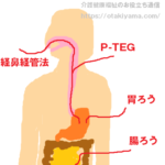 経鼻胃管、胃瘻（胃ろう）、P-TEG、腸ろうの種類の違いの図、フリー素材