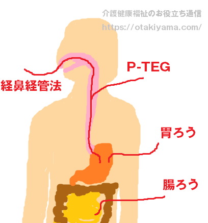 経鼻胃管、胃瘻（胃ろう）、P-TEG、腸ろうの種類の違いの図、フリー素材