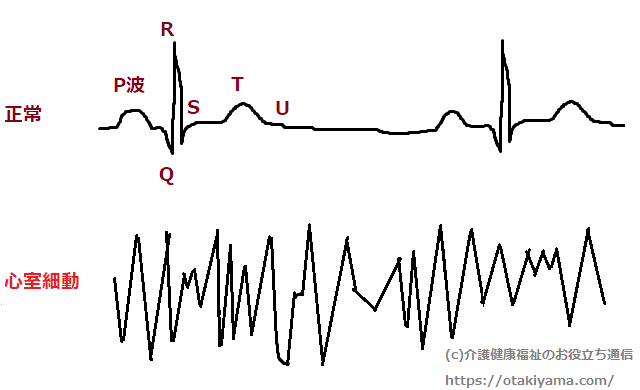 心室細動の心電図と正常心電図の違いの図 画像