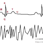 心室細動の心電図と正常心電図の違いの図・画像