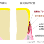 吐息のニオイ（口臭）の原因と対策方法、歯周病、介護現場での口腔ケア、舌苔対策