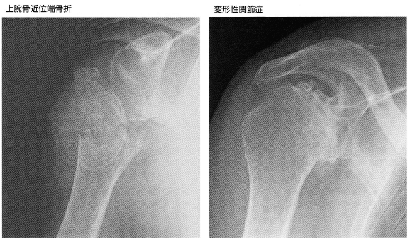 骨折の写真 癒合期間