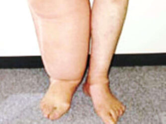 浮腫とは むくみの種類と原因ごとの症状