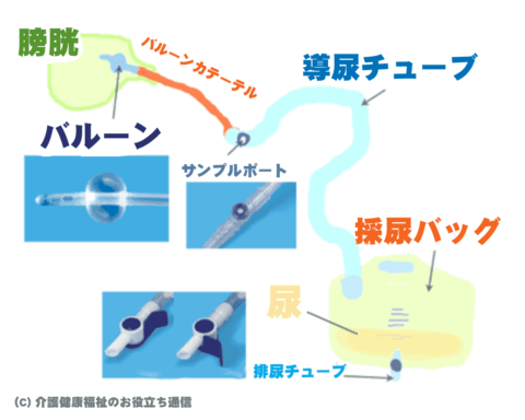 ハルンバッグとは？ ウロ・バルーンなど意味の違いや注意点 | 介護健康福祉のお役立ち通信