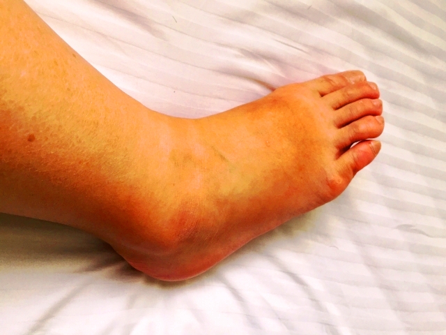 蜂窩織炎とは　介護看護で足などの患部を挙上する理由