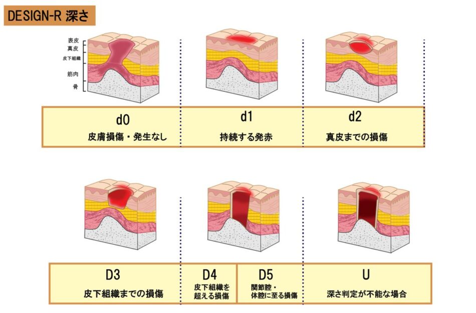 DESIGN-Rでの深さ(D)の評価方法・評価基準