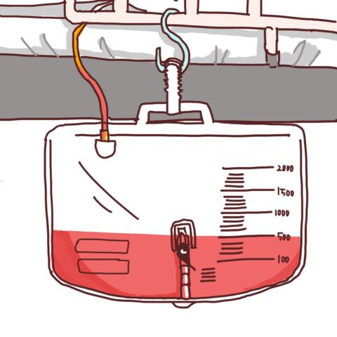 膀胱留置カテーテル・蓄尿バック使用者の血尿観察