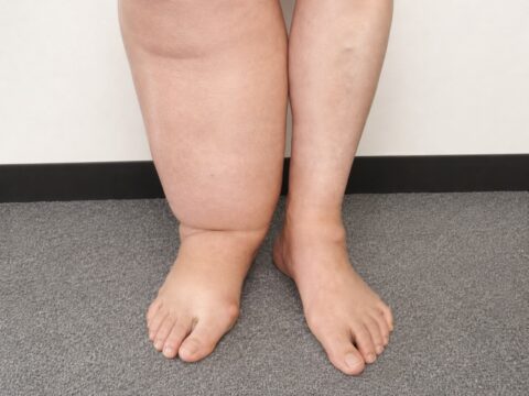 浮腫とは？むくみの種類と原因ごとの症状、評価スケール・確認テスト