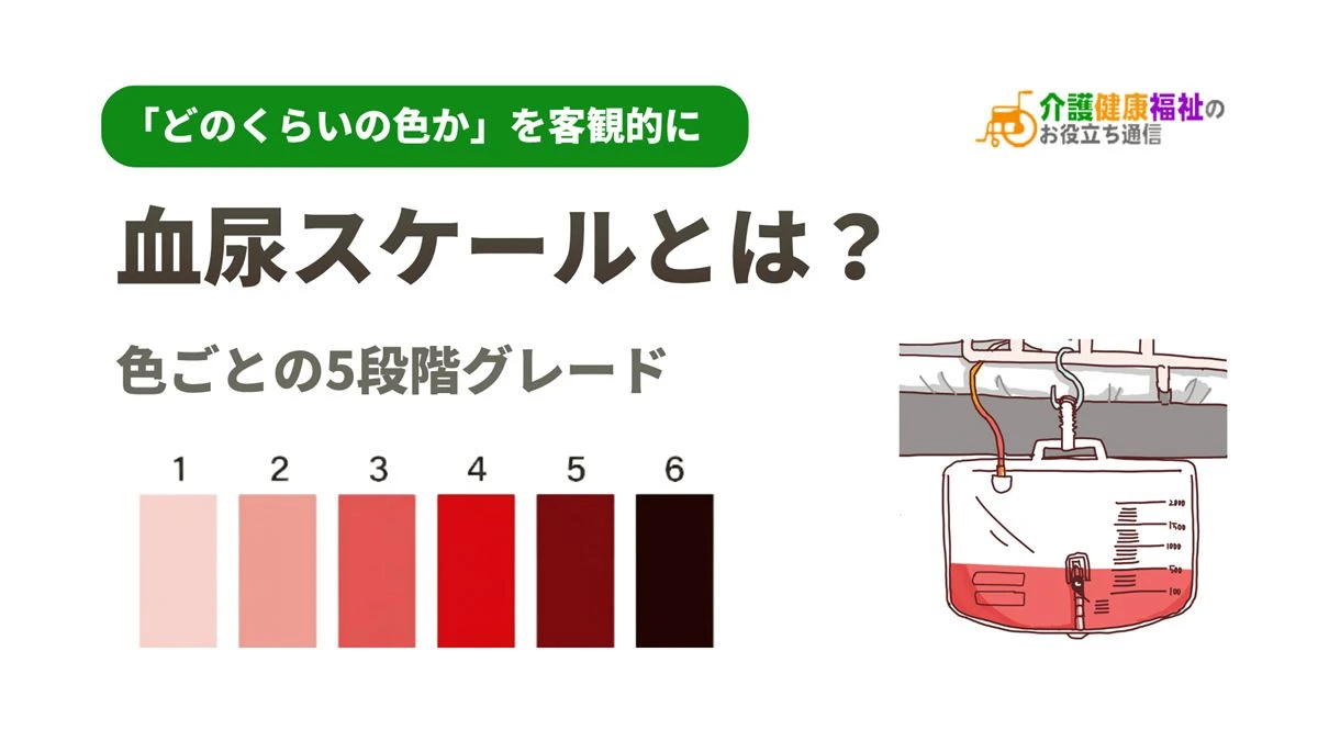 血尿スケールとは？色ごとの5段階グレード、介護で状態確認のポイント